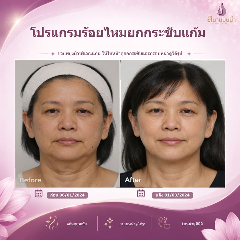 ภาพก่อน–หลัง ร้อยไหมแก้ม กรณีเฉพาะบุคคล