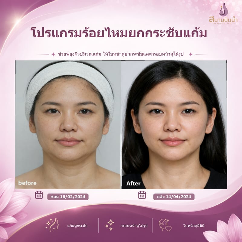 ภาพก่อน–หลัง ร้อยไหมแก้ม กรณีเฉพาะบุคคล