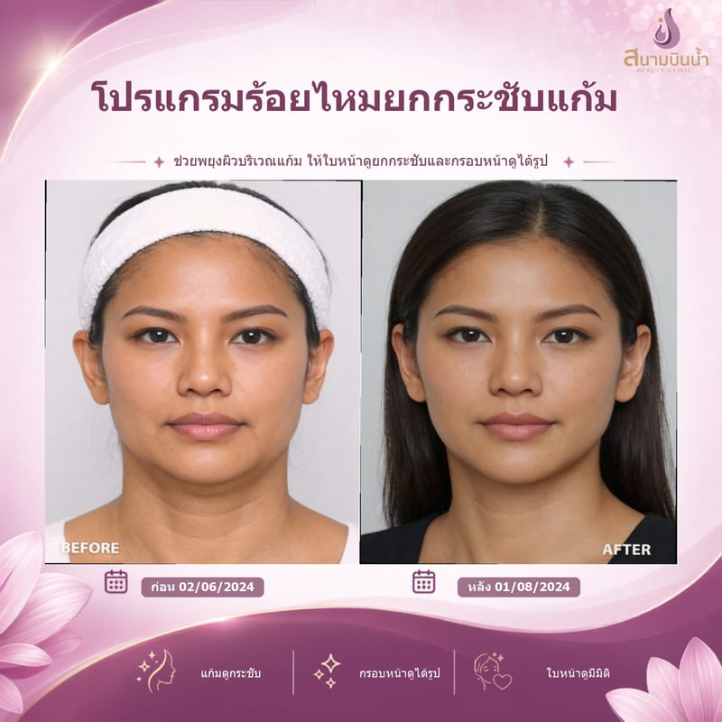ภาพก่อน–หลัง ร้อยไหมแก้ม กรณีเฉพาะบุคคล