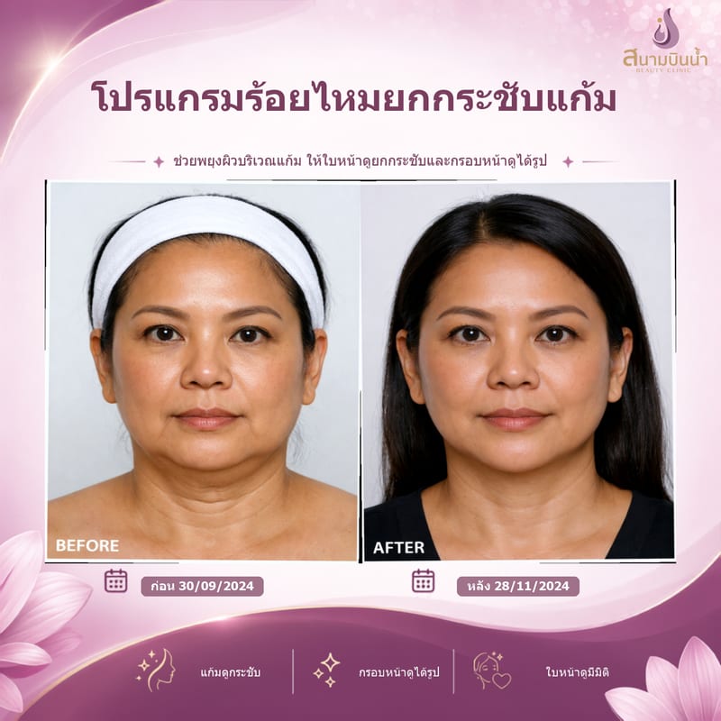 ภาพก่อน–หลัง ร้อยไหมแก้ม กรณีเฉพาะบุคคล