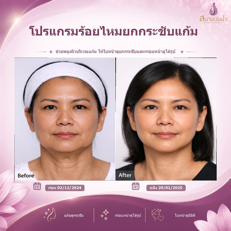ภาพก่อน–หลัง ร้อยไหมแก้ม กรณีเฉพาะบุคคล