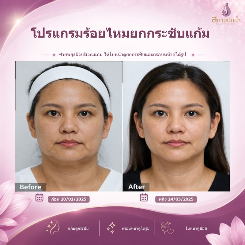 ภาพก่อน–หลัง ร้อยไหมแก้ม กรณีเฉพาะบุคคล