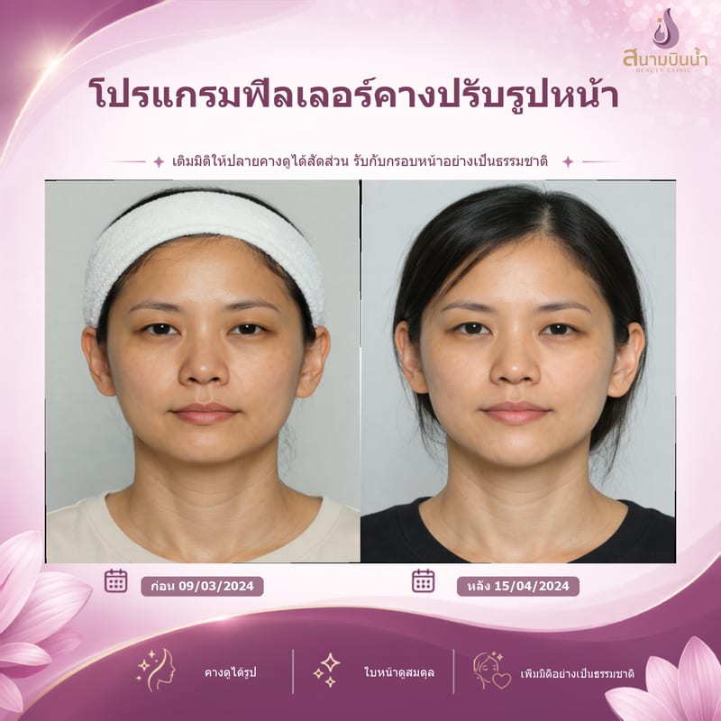 ภาพก่อน–หลัง ฟิลเลอร์คาง กรณีเฉพาะบุคคล