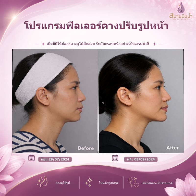 ภาพก่อน–หลัง ฟิลเลอร์คาง กรณีเฉพาะบุคคล