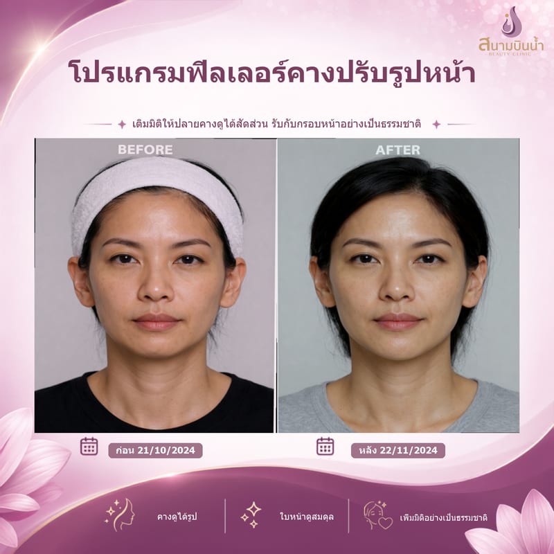 ภาพก่อน–หลัง ฟิลเลอร์คาง กรณีเฉพาะบุคคล