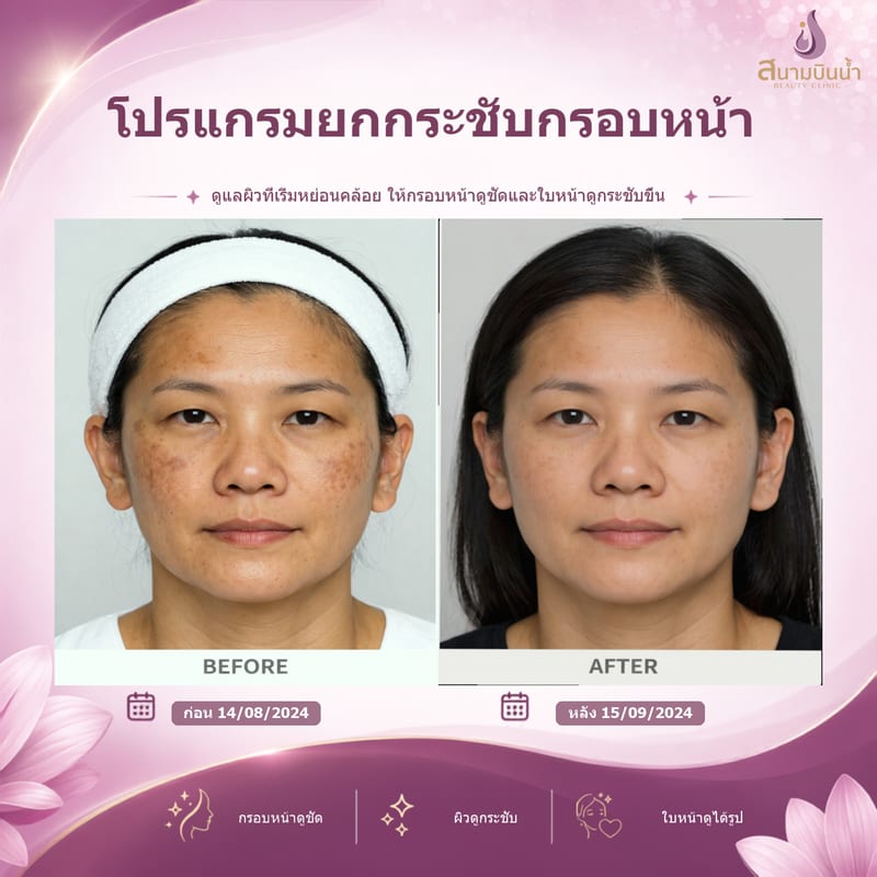 ภาพก่อน–หลัง ยกกระชับกรอบหน้า กรณีเฉพาะบุคคล