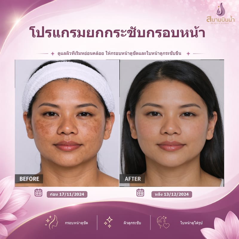 ภาพก่อน–หลัง ยกกระชับกรอบหน้า กรณีเฉพาะบุคคล