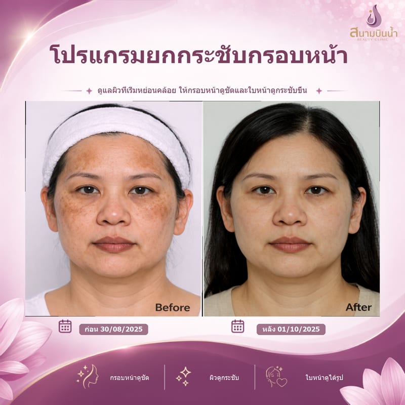 ภาพก่อน–หลัง ยกกระชับกรอบหน้า กรณีเฉพาะบุคคล