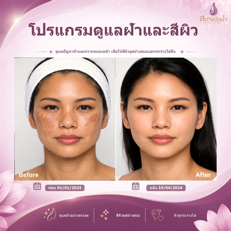 ภาพก่อน–หลัง รักษาฝ้า กรณีเฉพาะบุคคล