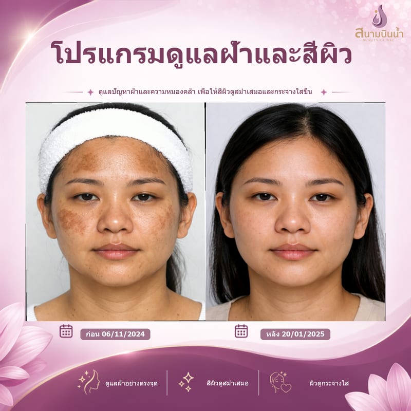 ภาพก่อน–หลัง รักษาฝ้า กรณีเฉพาะบุคคล