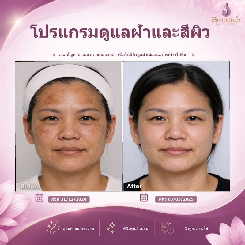 ภาพก่อน–หลัง รักษาฝ้า กรณีเฉพาะบุคคล