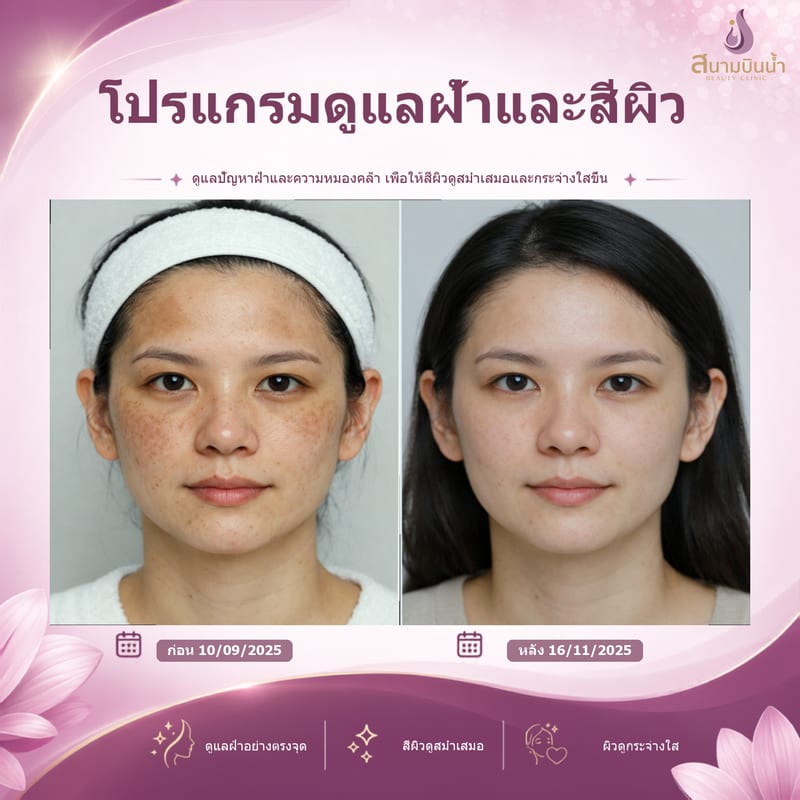 ภาพก่อน–หลัง รักษาฝ้า กรณีเฉพาะบุคคล