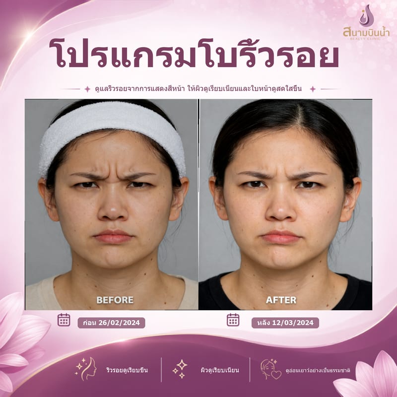 ภาพก่อน–หลัง โบท็อกซ์ริ้วรอย กรณีเฉพาะบุคคล