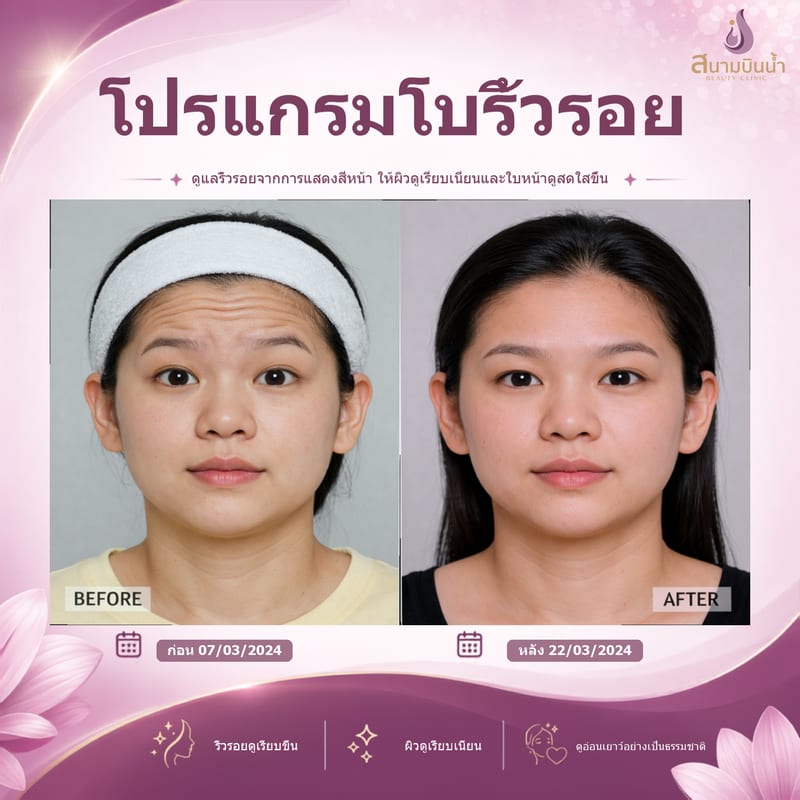 ภาพก่อน–หลัง โบท็อกซ์ริ้วรอย กรณีเฉพาะบุคคล