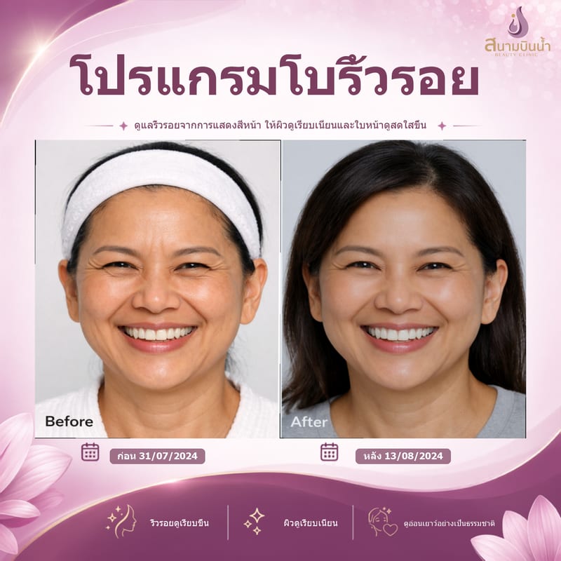 ภาพก่อน–หลัง โบท็อกซ์ริ้วรอย กรณีเฉพาะบุคคล