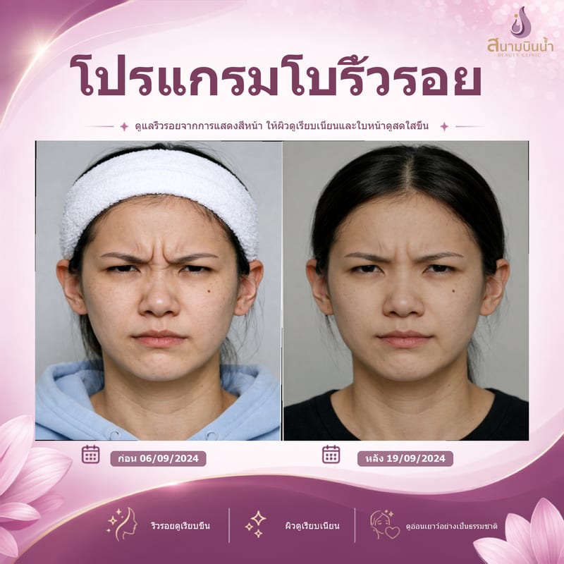 ภาพก่อน–หลัง โบท็อกซ์ริ้วรอย กรณีเฉพาะบุคคล