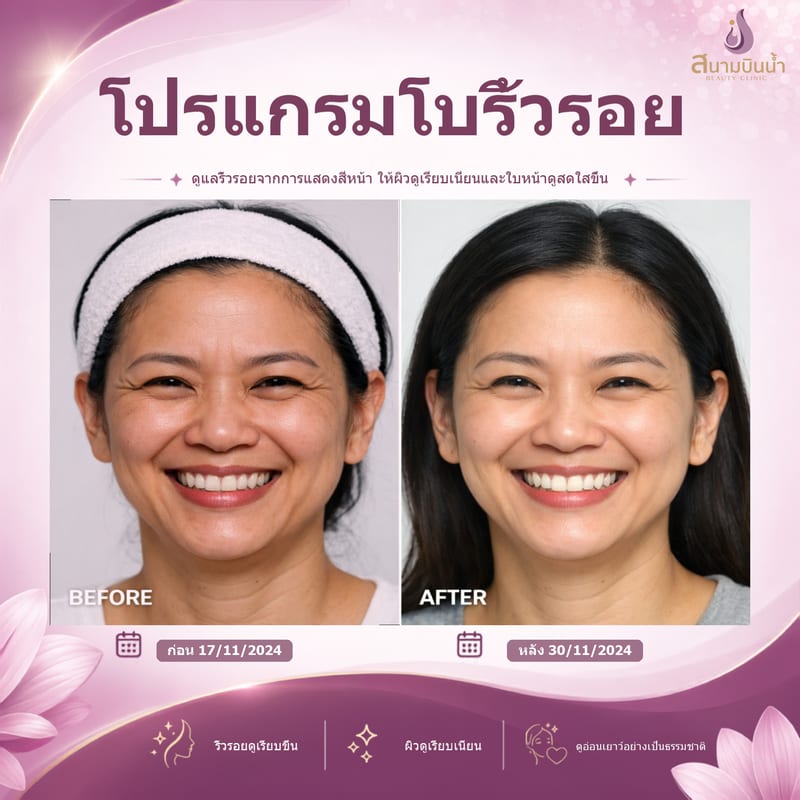 ภาพก่อน–หลัง โบท็อกซ์ริ้วรอย กรณีเฉพาะบุคคล