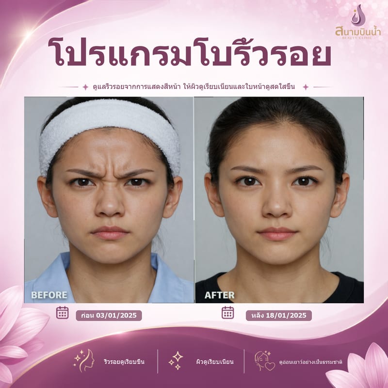 ภาพก่อน–หลัง โบท็อกซ์ริ้วรอย กรณีเฉพาะบุคคล