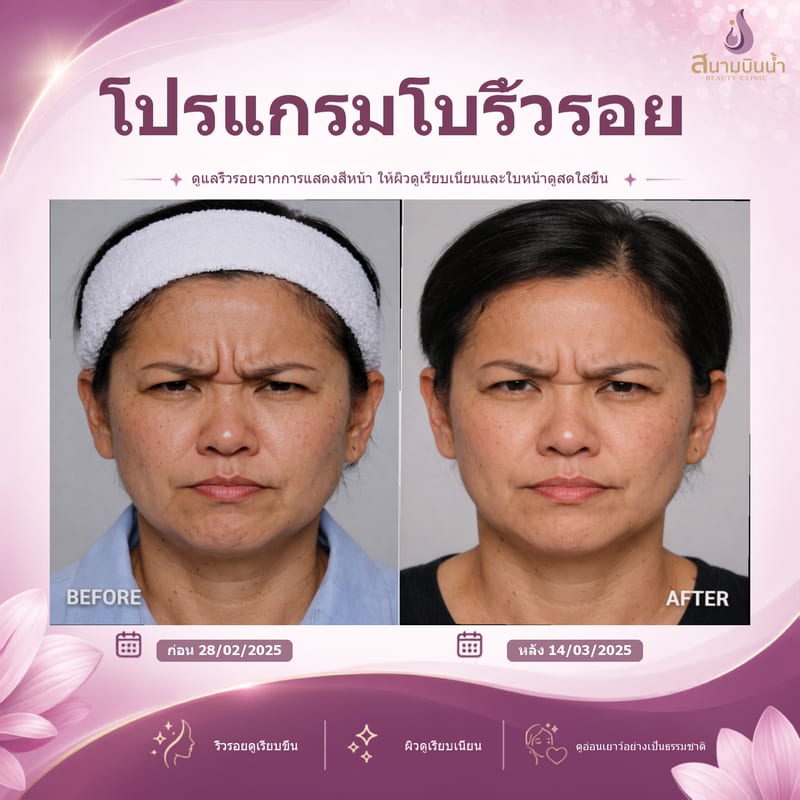 ภาพก่อน–หลัง โบท็อกซ์ริ้วรอย กรณีเฉพาะบุคคล