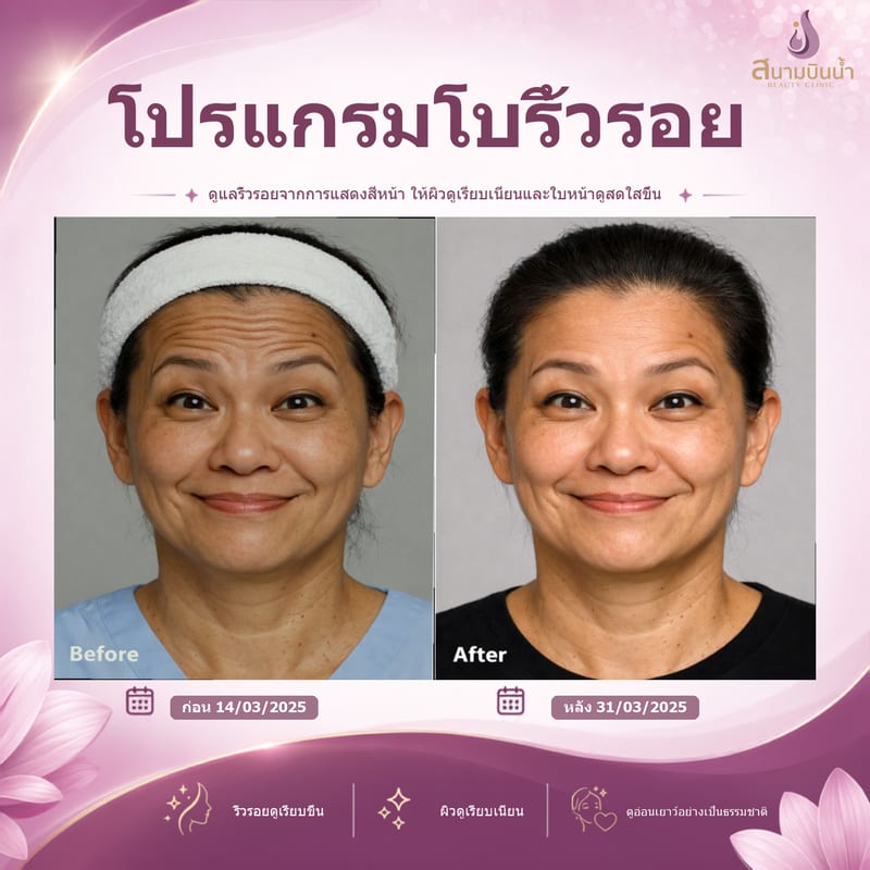 ภาพก่อน–หลัง โบท็อกซ์ริ้วรอย กรณีเฉพาะบุคคล