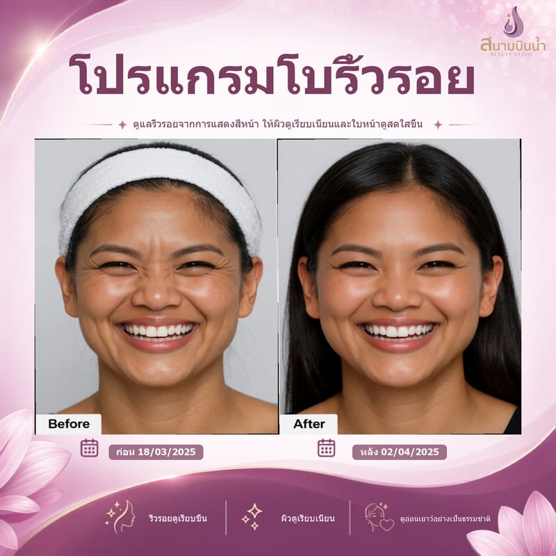 ภาพก่อน–หลัง โบท็อกซ์ริ้วรอย กรณีเฉพาะบุคคล