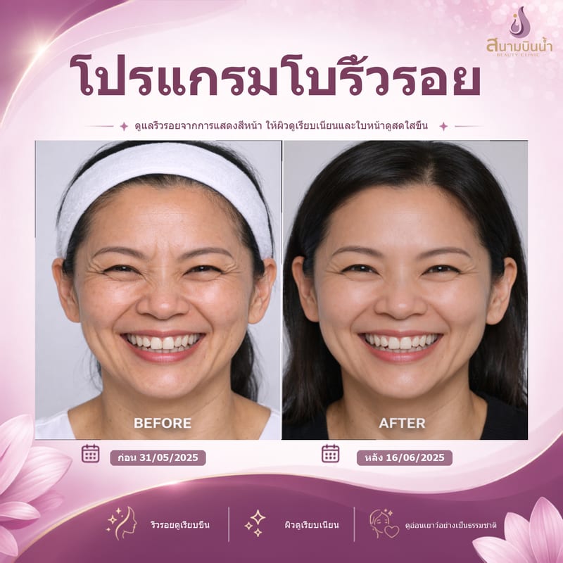 ภาพก่อน–หลัง โบท็อกซ์ริ้วรอย กรณีเฉพาะบุคคล