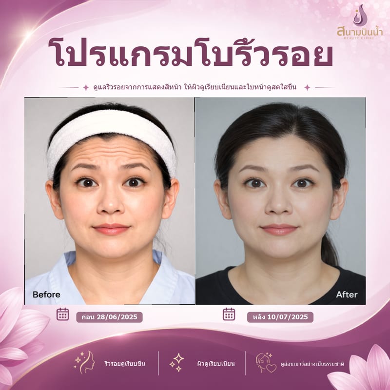 ภาพก่อน–หลัง โบท็อกซ์ริ้วรอย กรณีเฉพาะบุคคล
