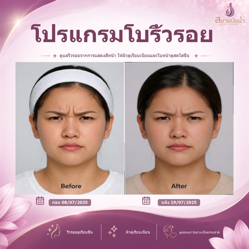 ภาพก่อน–หลัง โบท็อกซ์ริ้วรอย กรณีเฉพาะบุคคล